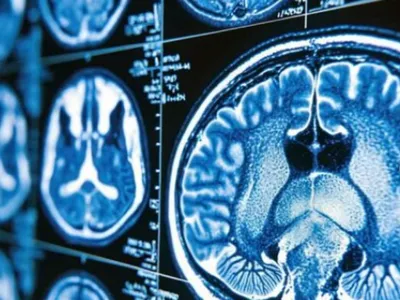 29 octobre : Journée mondiale de lutte contre l’AVC, chaque minute...