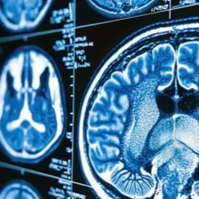 29 octobre : Journée mondiale de lutte contre l’AVC, chaque minute...