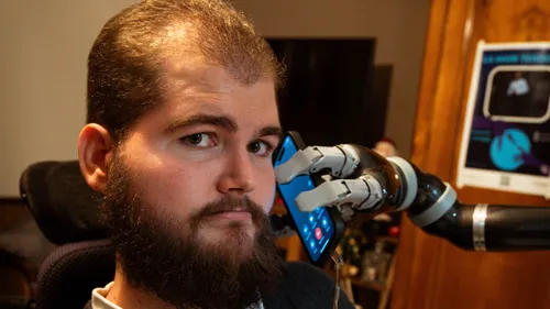 Un bras bionique pour gagner en autonomie face au handicap