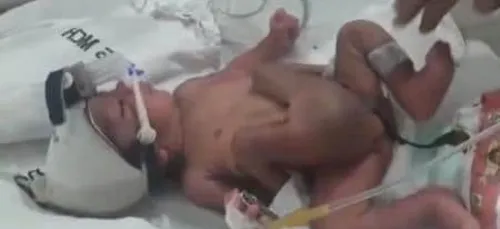(Vidéo) En Inde, un bébé nait avec deux paires de jambes et deux...