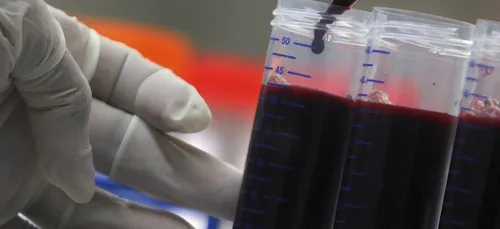 5 patients guérissent du SIDA grâce à un étrange cocktail de...