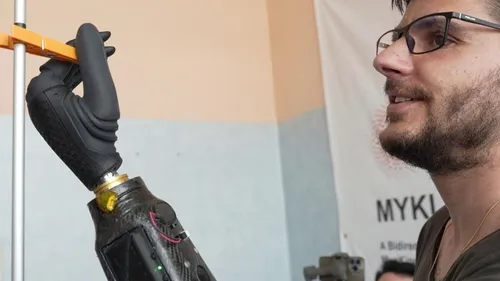 Daniel, 34 ans, retrouve l’usage de sa main amputée grâce à cette...