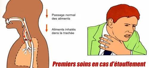 Que faire si vous vous étouffez alors que vous êtes seul ? (vidéo)