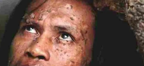 #Rip L'homme arbre indonésien est décédé (vidéo)