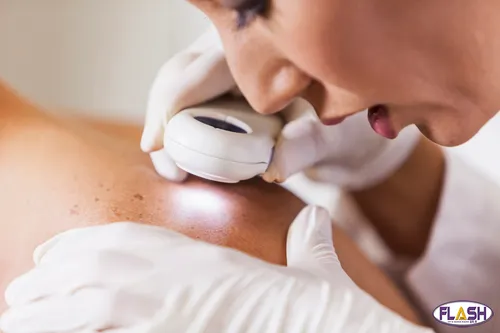 Dépistage gratuit des cancers de la peau