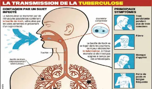 Un cas de tuberculose détecté à l'école des Feuillants