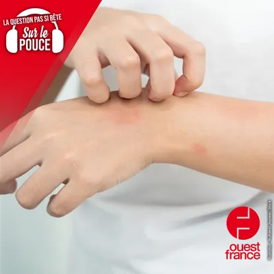 Pourquoi ne faut-il pas gratter ses piqures de moustiques ?