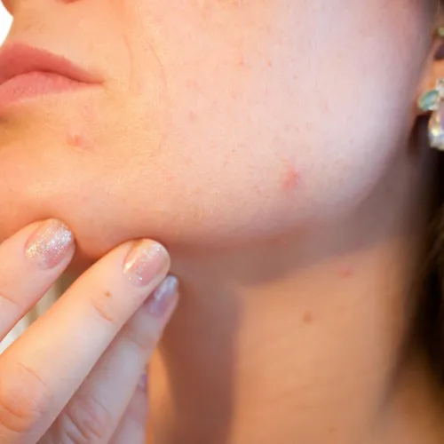 Le stress peut-il donner des boutons ?