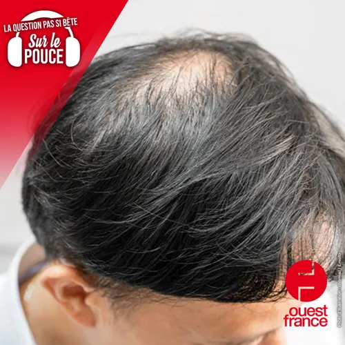 Quelles sont les causes de la calvitie ?