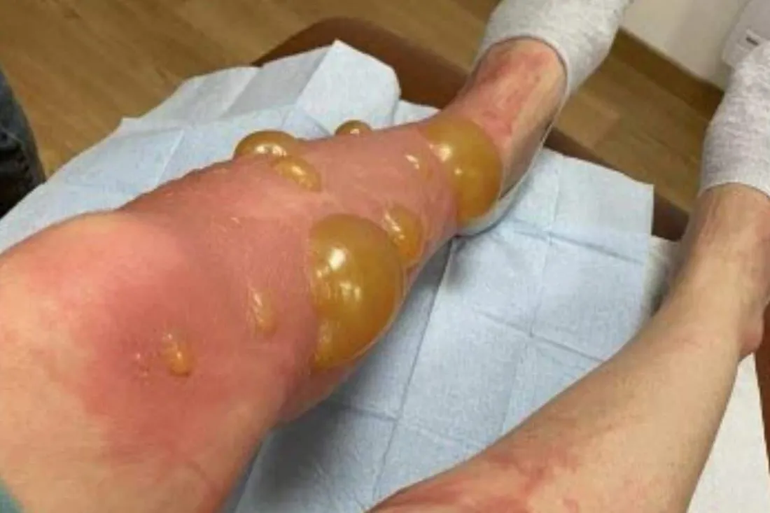 Une baignade dans un lac vire au cauchemar avec l'apparition de cloques