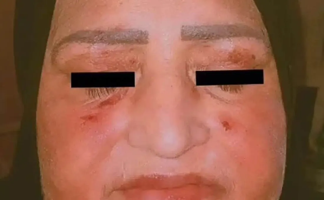 Une femme se retrouve avec des écailles de serpent à cause de l'ibuprofène !