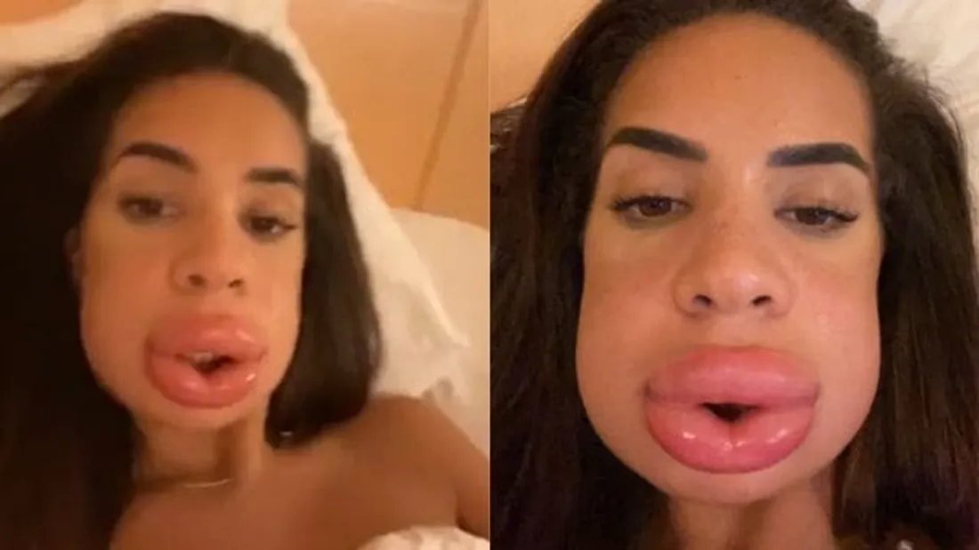 Marwa est défigurée par la chirurgie et frôle la mort !