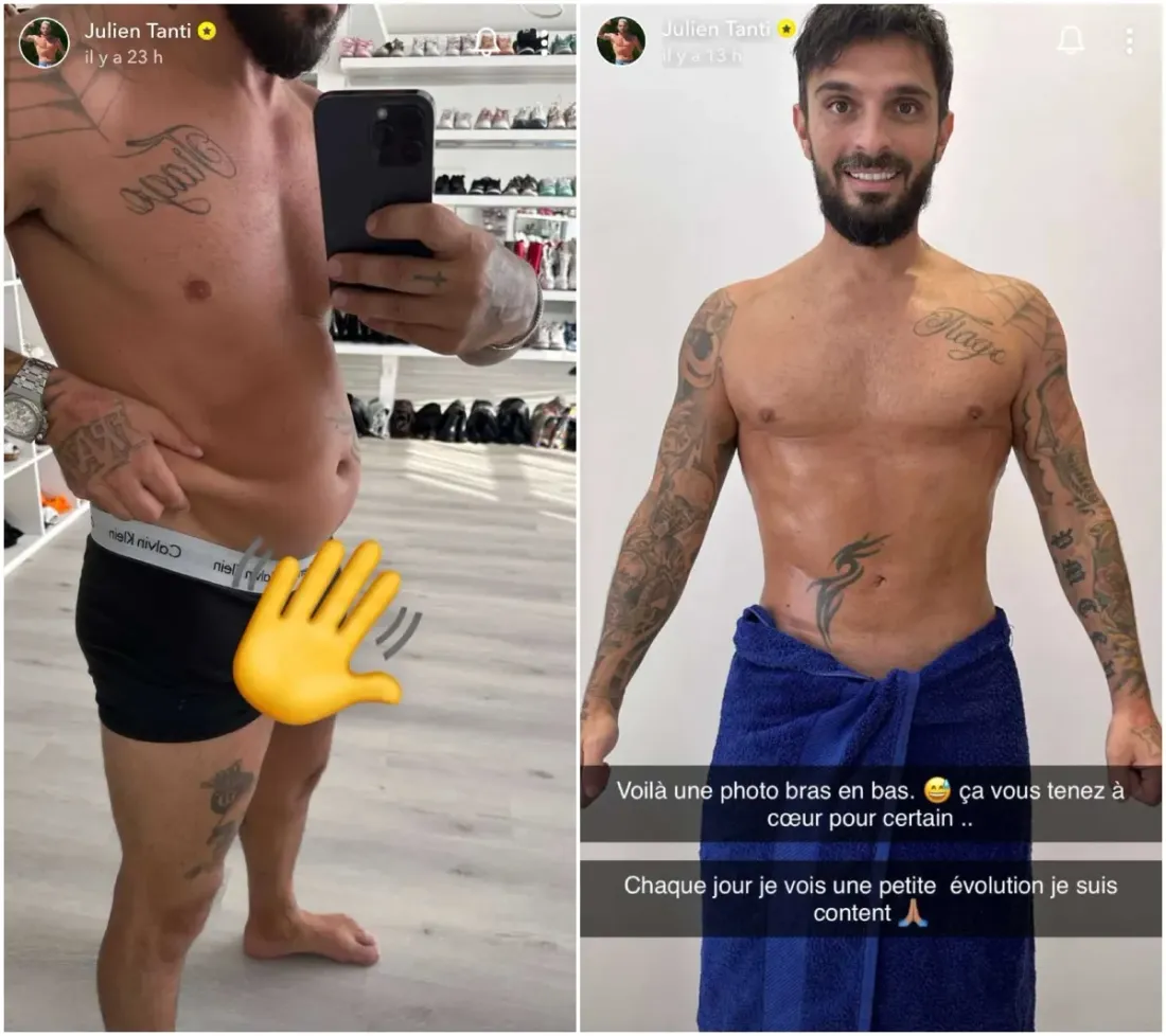 Le chirurgien de Julien Tanti dévoile le avant-après de sa liposuccion !