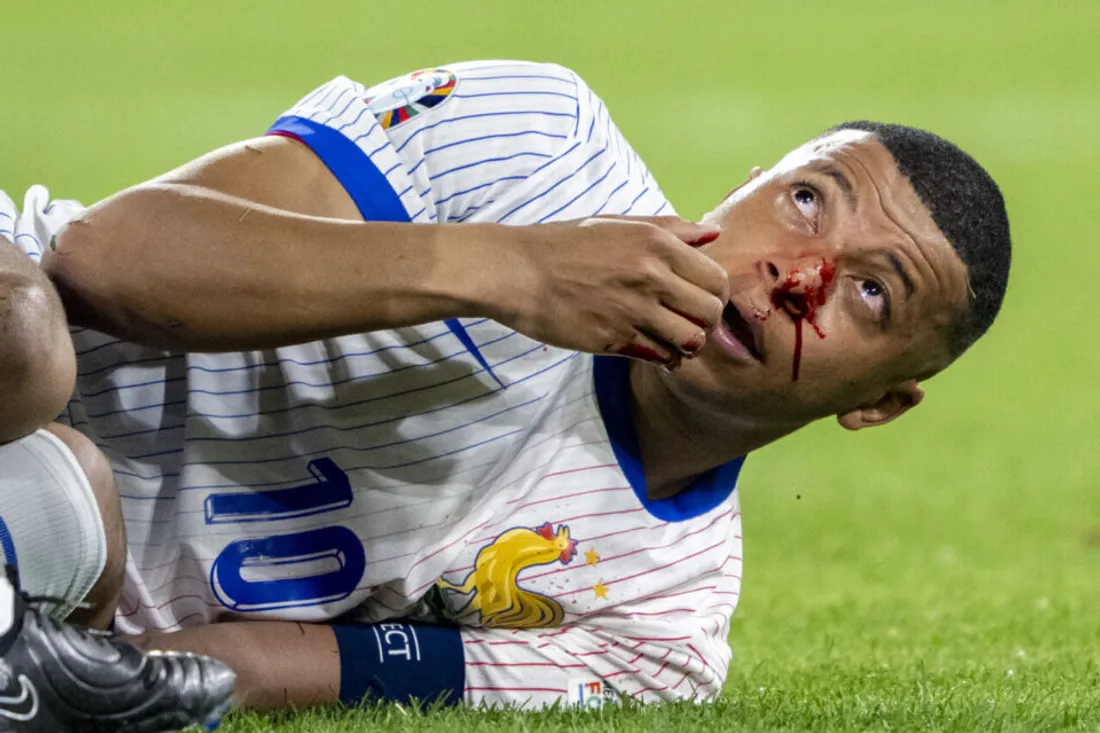 La fracture du nez de Mbappé va-t-elle impacter ses performances ?