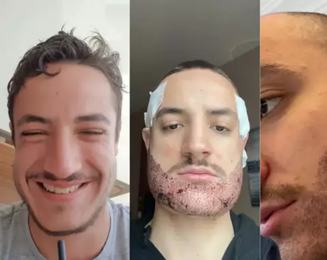 Drame de la chirurgie esthétique : un jeune homme se donne la mort suite à une greffe de barbe 
