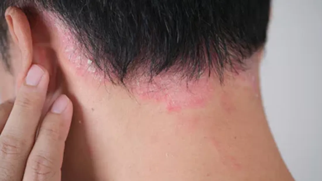  Découverte de l'importance de l’hormone hepcidine dans les poussées inflammatoires du psoriasis