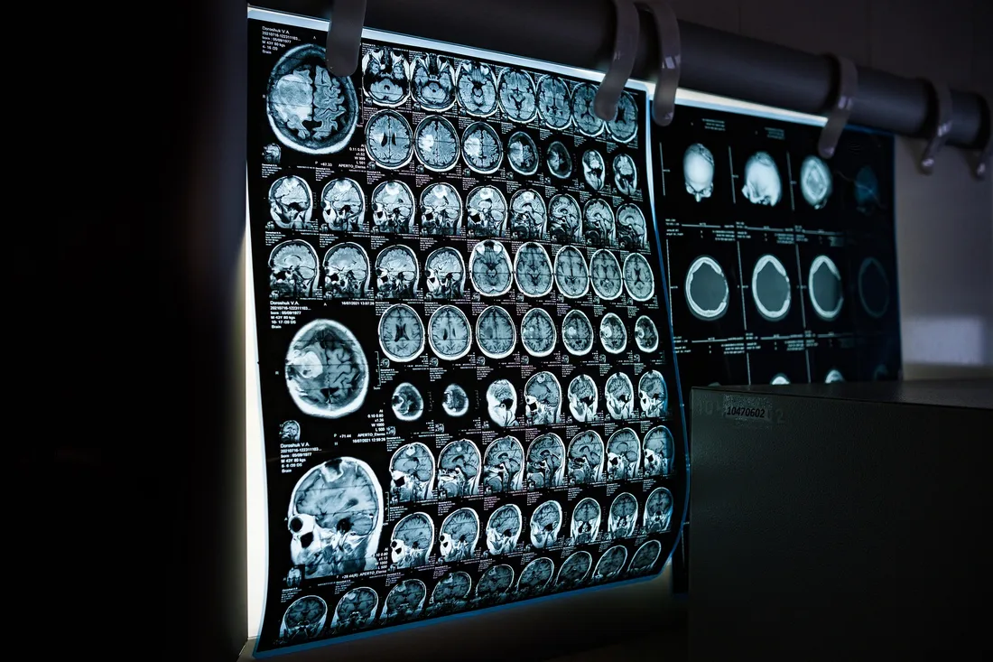 irm cerveau