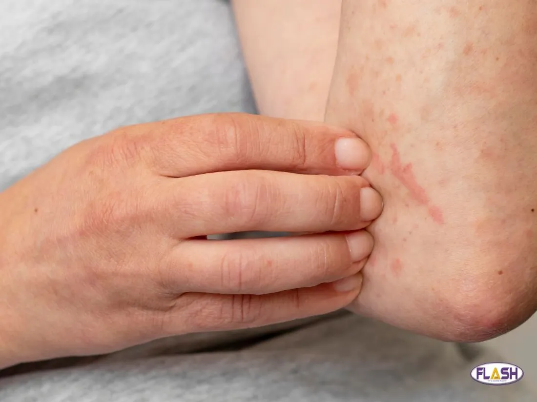 Rougeole Illustration 150424