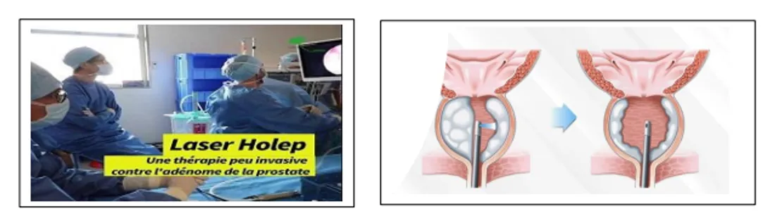 La procédure du laser HoLep