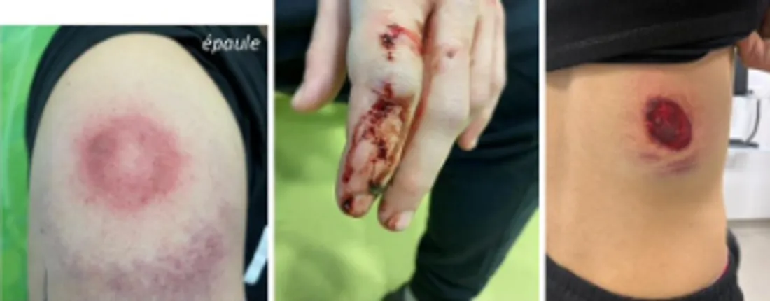 Les blessures d'après le communiqué des Green Angels.