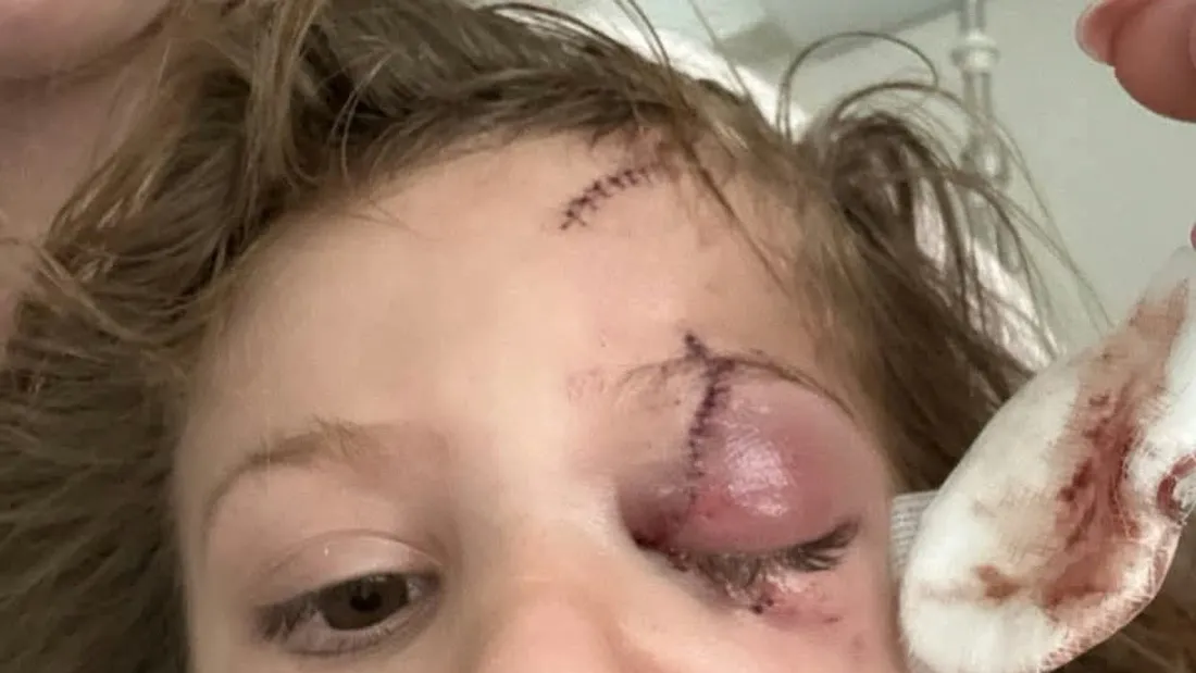 La petite fille de 5 ans, mordue au visage par un chien a failli perdre son œil.
