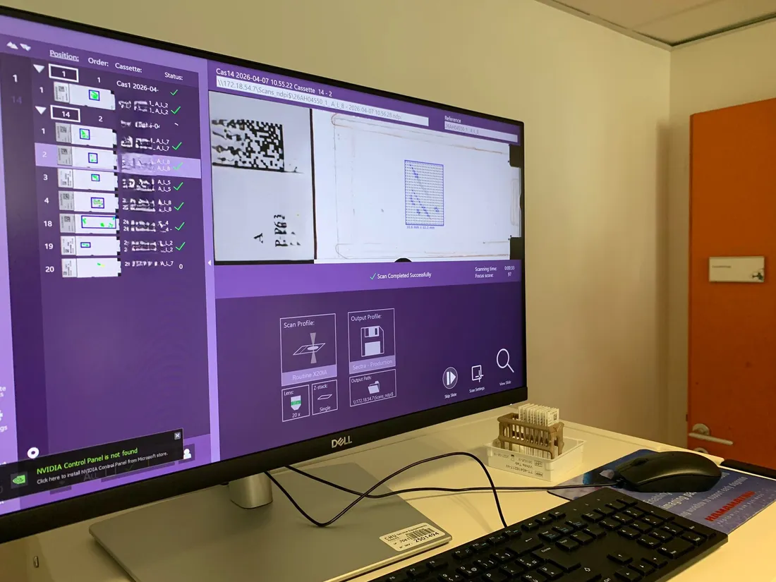 Scanner lames CHU d'Angers_07 04 26_AVC