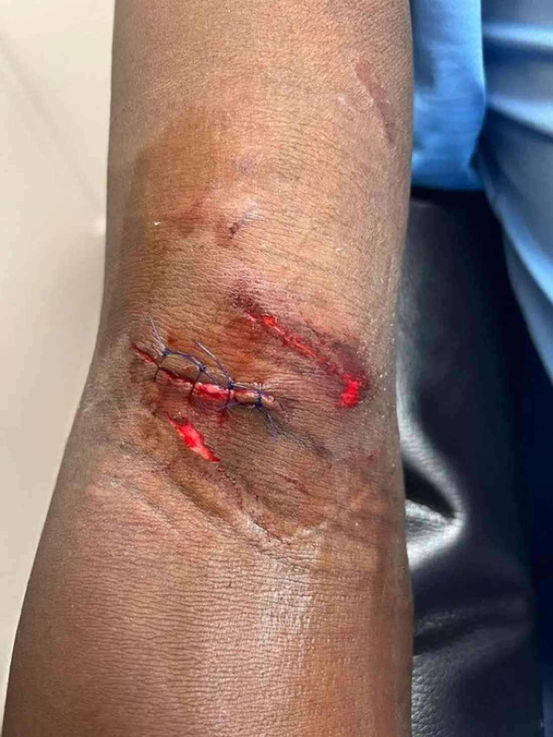 Le blessure et les points de sutures de Mamadou Samassa.