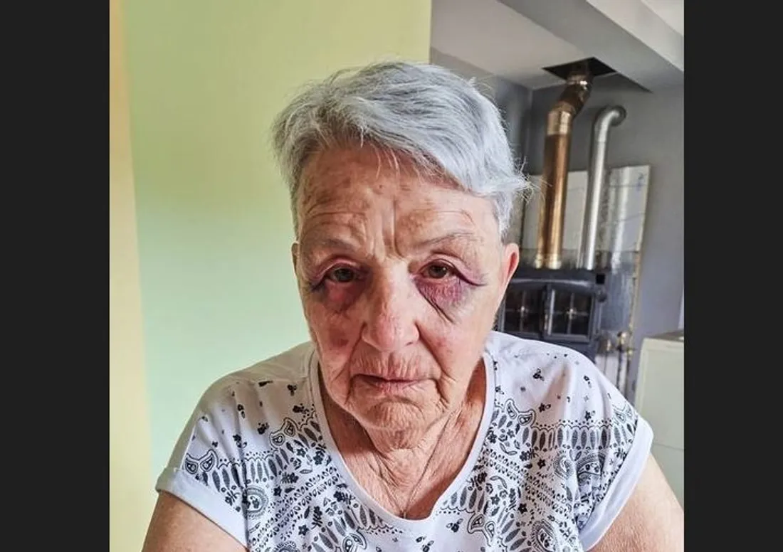 Le visage tuméfiée de l'élue agressée lundi soir 