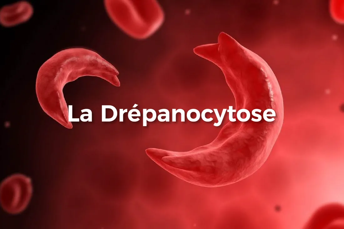 Maladie : la drépanocytose