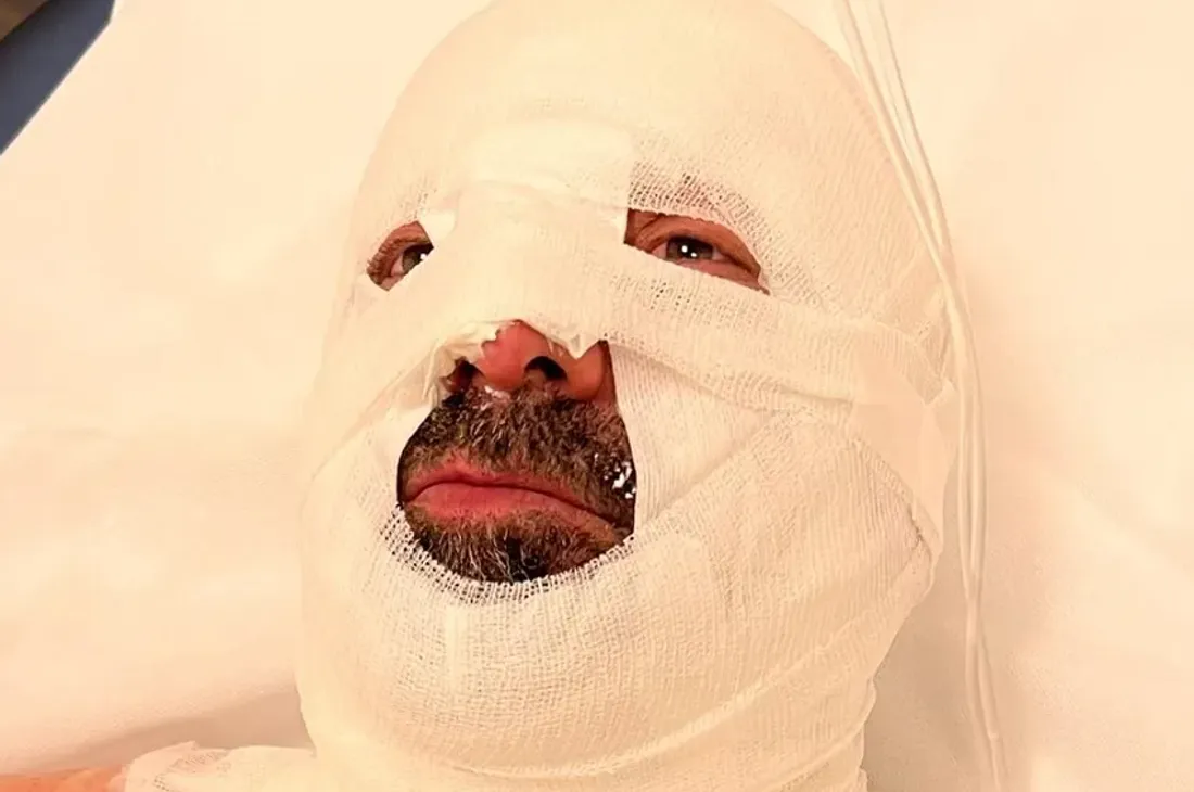 D'impressionnants bandages sur le visage