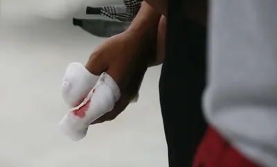 Brûlure aux doigts_nouvel an