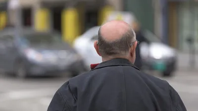 En Corée du Sud, la calvitie bientôt remboursée par la Sécurité...