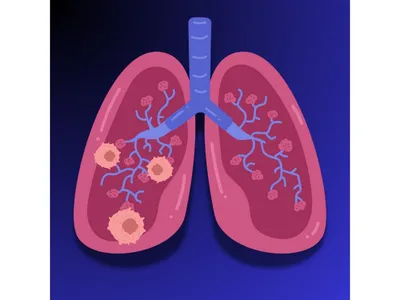 France : le cancer du poumon devient la première cause de mortalité...