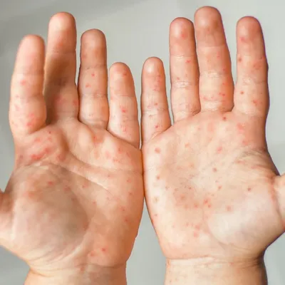 Une école du Morbihan touchée par une possible épidémie de gale