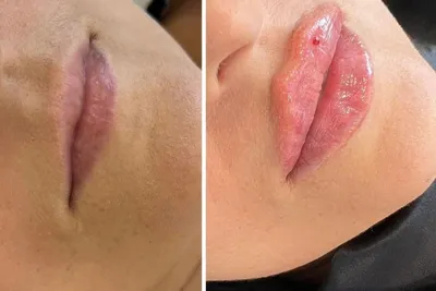 Une femme meurt après une injection clandestine, les spécialistes...