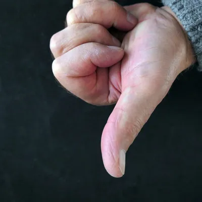 Santé : la plateforme « Arthrose Pouce » brise le silence autour du...
