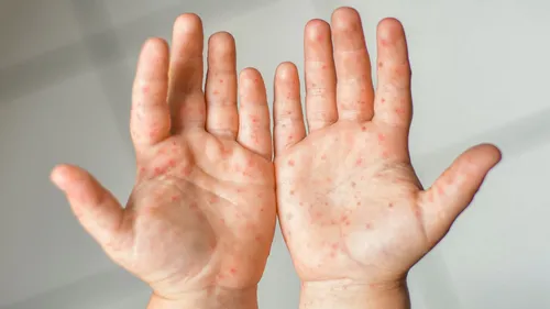 Fausse alerte : pas d’épidémie de gale dans ces deux écoles du...