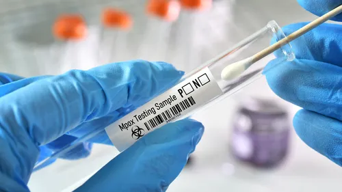 Mpox : une Bretonne contaminée, premier cas du nouveau variant en...