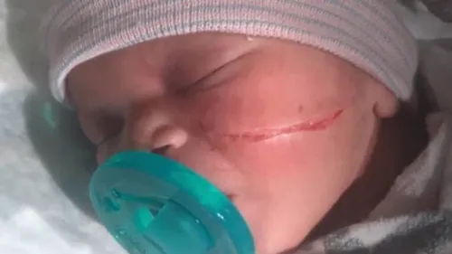 Naissance : un bébé reçoit 13 points de suture après une césarienne...