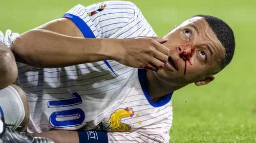 La fracture du nez de Mbappé va-t-elle impacter ses performances ?