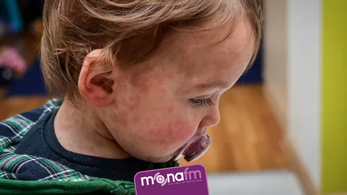 Rougeole : une circulation active du virus dans les Hauts-de-France