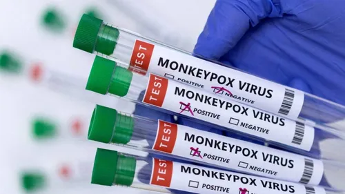 Virus mpox : un 1er cas d'un nouveau sous-variant identifié en France