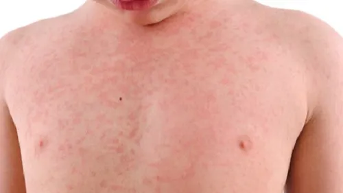 Le Nord particulièrement concerné par l'épidémie de rougeole 