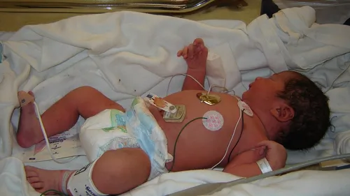 Bronchiolite : un médicament pour prévenir les formes graves