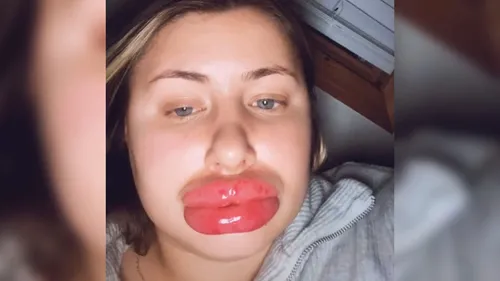 “Je ressemblais à une poupée gonflable” : sa dernière opération de...