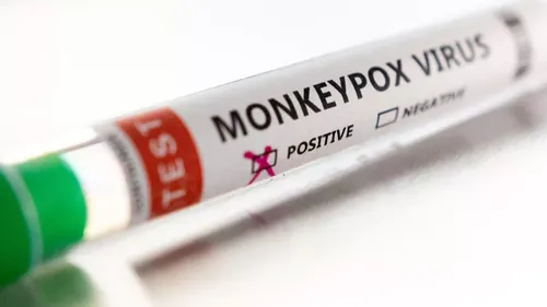 Un premier cas de variole du singe dans les Hauts-de-France