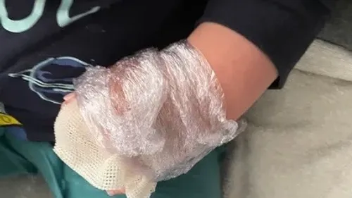 Outreau - Un enfant de 3 ans brûlé à l'eau bouillante, les excuses...