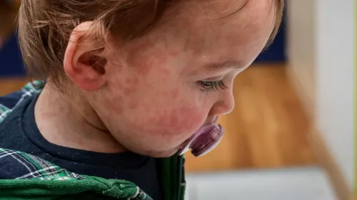 Attention, la Rougeole est de retour dans la Région