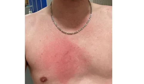 Tabassé par un ambulancier "anti-vax", ce soignant de Muret ne...