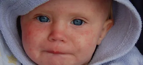 Bordeaux : épidémie de rougeole !